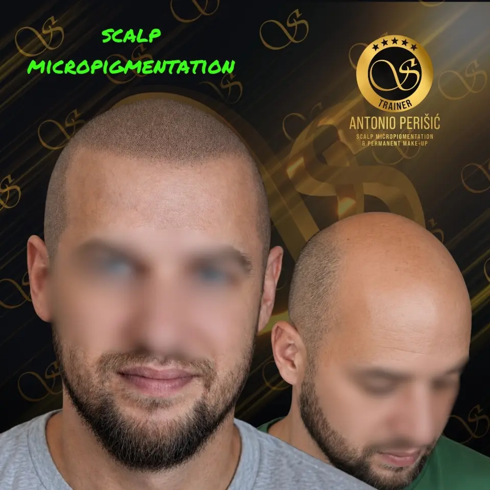 Problem koji muči svakog drugog muškarca: Do izgleda guste kose bez 'noža'