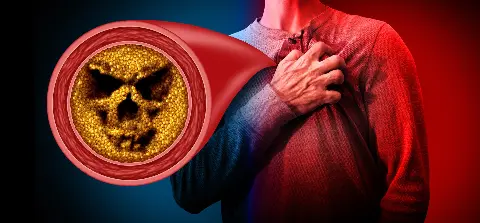 Prevencija vaskularnih bolesti: Rano otkrivanje ateroskleroze spašava život