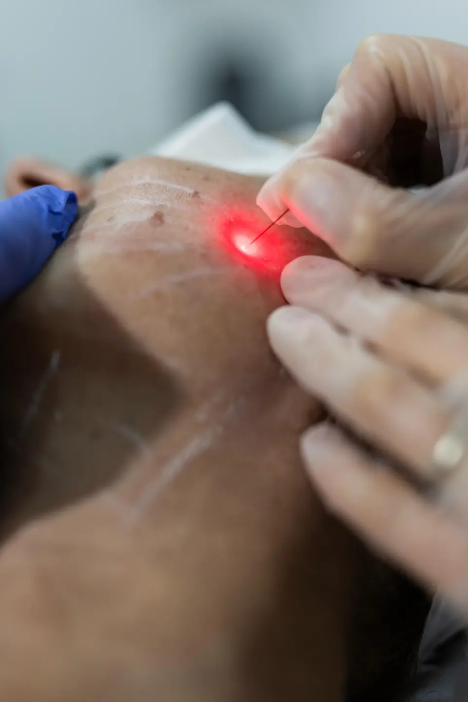 Skin Clinic Split donosi vrhunsku tehnologiju za mladolik izgled – Endolift®!