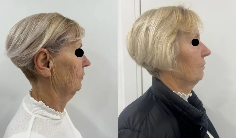 Skin Clinic Split donosi vrhunsku tehnologiju za mladolik izgled – Endolift®!