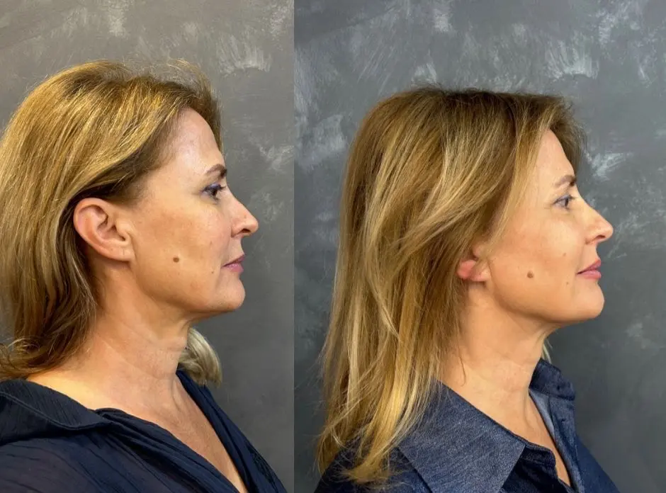 Skin Clinic Split donosi vrhunsku tehnologiju za mladolik izgled – Endolift®!