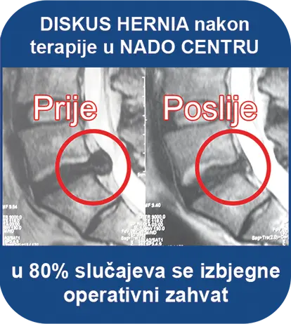 Za život bez boli: Više od 80% pacijenata izbjeglo bolove i operaciju kralježnice