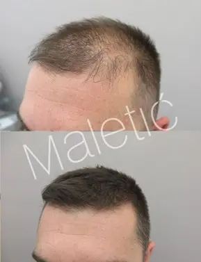 Zašto je Poliklinika Maletić vodeći centar za transplantaciju kose u regiji?