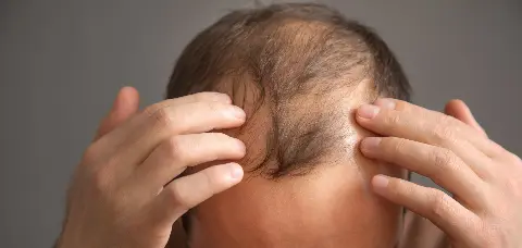 Z Brows & Beauty salon: transformacija kroz scalp micropigmentaciju